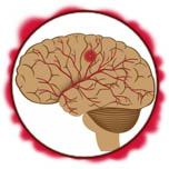 Болезни сосудов головного мозга, инсульт - следствие нарушения кровообращения либо разрыва сосудов мозга